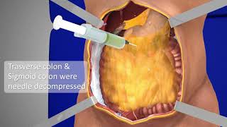 Exploratory Laparotomy  3D Medical Animation  Part  1  Films Blueray [upl. by Sana]