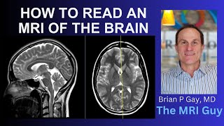 How to read an MRI of the brain  First Look MRI [upl. by Nealy]