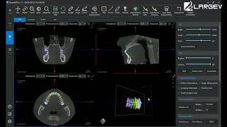 Software de análisis dental LargeV AI Simulación de Implantes [upl. by Aneram]