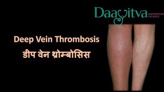 DEEP VEIN THROMBOSIS DVT डीप वेन थ्रोम्बोसिसtreatment [upl. by Eiger]