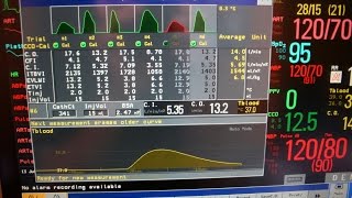 Cardiac output the longer version [upl. by Zerline720]