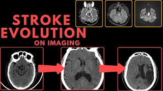 Stroke Evolution on CT and MRI Imaging [upl. by Marrissa]