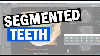 19 Orthognathic Treatment plans Tooth amp Bone Segmentation [upl. by Faxan]