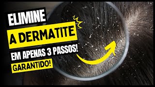 ELIMINE A DERMATITE SEBORREICA EM APENAS 3 PASSOS [upl. by Aridatha340]