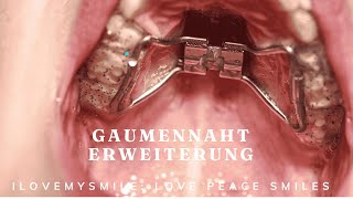 Gaumennahterweiterung was ist das [upl. by Arbed]