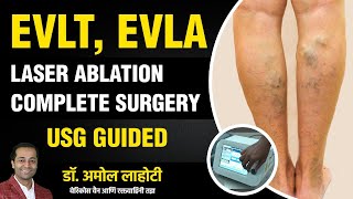 Live Varicose Vein Laser Surgery Full Live Procedure Explained By Dr Amol Lahoti [upl. by Arivle]