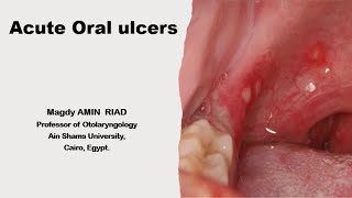 I Acute Oral Ulcers [upl. by Eisinger249]