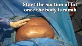 How is liposuction performed  Centre for Surgery [upl. by Rabma786]