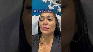 The TRUTH About Lip Fillers You Need to Know with Dr Dahabra in Florida shorts [upl. by Wurster769]