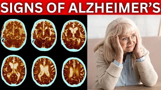 10 Early Signs Of Alzheimers [upl. by Akyssej]