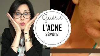 Lacné sévère  en guérir naturellement [upl. by Inge]