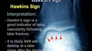 Talus Fracture  Hawkins Sign  Everything You Need To Know  Dr Nabil Ebraheim [upl. by Rois800]