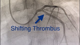 Thrombus Shifts to LCX Acute Anterior MI Cardiogenic Shock Ostial LAD Occlusion How To Treat [upl. by Shepperd821]