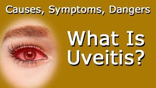 What Is Uveitis Causes Symptoms Dangers To Your Vision [upl. by Dee]