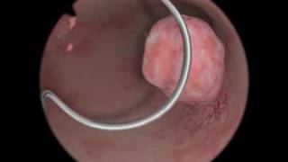 Polypectomy  Polyp Removal  Virtual Reality Simulation for Endoscopic Surgery [upl. by Ehcram]