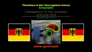 Sonographie  Thrombose In Der Vena Jugularis Interna [upl. by Gonsalve]