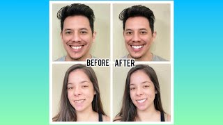 WE TRIED SHINY SMILE SNAP ON VENEERS Review  Update [upl. by Duarte]