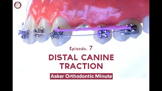 Distal Canine Traction Asker Orthodontic Minute Episode 7 [upl. by Nylicaj371]