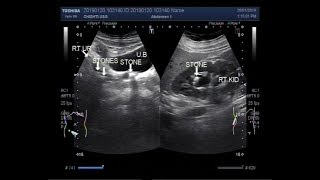 Ultrasound Video showing a renal stone with multiple ureteric stones [upl. by Auehsoj712]