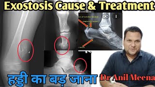 Exostosis Treatment  Exostosis cause and treatment  Osteochndroma  Osteophyte  Osteoma In Hindi [upl. by Aiym779]