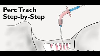 Percutaneous Tracheostomy Demo  Tracheostomy [upl. by Maro]