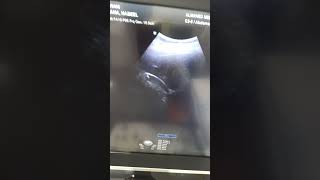 Our gallbladder on ultrasound imaging youtubeshorts shortvideo [upl. by Octavius407]