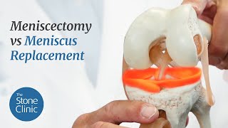 Meniscectomy vs Meniscus Replacement  Meniscus Tear Treatment Options [upl. by Alis]