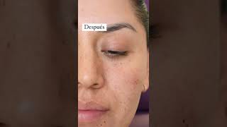 Aplicación de Ácido Hialuronico en Ojeras 😨✔ skincare derma botox ácidohialurônico filler [upl. by Asnerek]