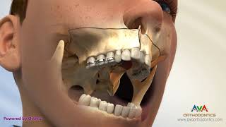 Surgical Orthodontic Treatment for Constricted Upper Jaw  SARPE [upl. by Annauqal]