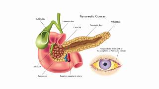 Pancreatic Diseases  English  The Gastro Specialist [upl. by Morgenthaler164]