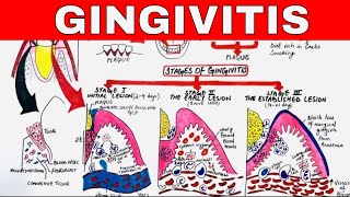 Gingivitis  Stages of Gingival Inflammation [upl. by Ardnuahc]