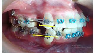 ¡COMO CEPILLARSE LOS DIENTES 👅 CON BRACKETS La GUIA MAXIMA 🙌 [upl. by Affra]