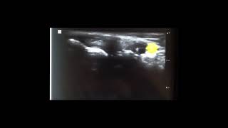 Ultrasound Guided Posterior Tibial Tendon Injection [upl. by Aylatan]