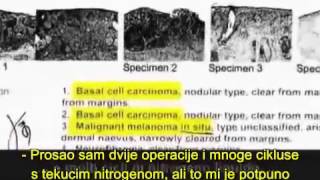 Izliječio rak kože s tinkturom joda lugolova otopina [upl. by Zeke]