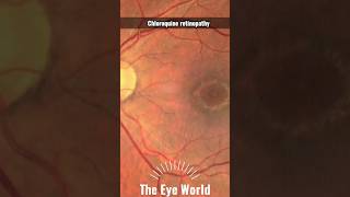 Chloroquine retinopathy is a form of toxic retinopathy [upl. by Nwahsit80]