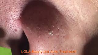 Whats That Crater Acne Removal 26 Full Screen Super Big Pops [upl. by Gorey]