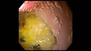 Duodenal ulcer [upl. by Gulick338]