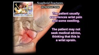 Scaphoid Fractures  Everything You Need To Know  Dr Nabil Ebraheim [upl. by Odnaloy650]