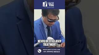 Nevus of OTA Laser Treatment  Birthmark Removal Treatment  Dr PK Talwar [upl. by Euqinehs]