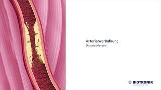 Arterienverkalkung Arteriosklerose und Angiografie [upl. by Sunil]