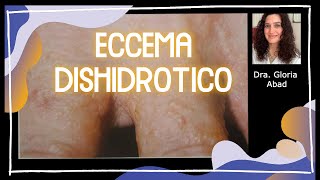 ¿Qué son las bombitas de agua que salen en la piel ECCEMA DISHIDRÓTICO 💧💦 DISHIDROSIS [upl. by Waki]