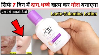 Lacto Calamine Face Lotion Review  lacto calamine face lotion kaise use kare  lacto calamine [upl. by Caniff]