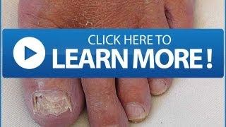 Black TOENAIL FUNGUS  Fungal Infection Information You Must Know [upl. by Iztim]