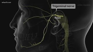 Trigeminal Neuralgia local doctors may have found the cure [upl. by Eciram]