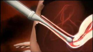 3D animation of how IVF works [upl. by Sergu]