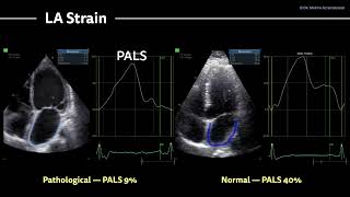 〖Echocardiography〗 Myocarditis  from HFrEF to heart transplant 💕 [upl. by Clement]