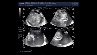 Ultrasound Video showing Hepatic Mass with hepatic parenchymal disease and ascites [upl. by Arahs]