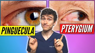 Pinguecula Vs Pterygium Signs Symptoms Treatment [upl. by Esinyl783]