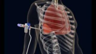 How to make a Thoracentesis pleural puncture with Pleurasafe [upl. by Dijam791]