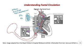 Preductal pulse oximetry  why does the probe always go on a newborns right hand [upl. by Aseela]